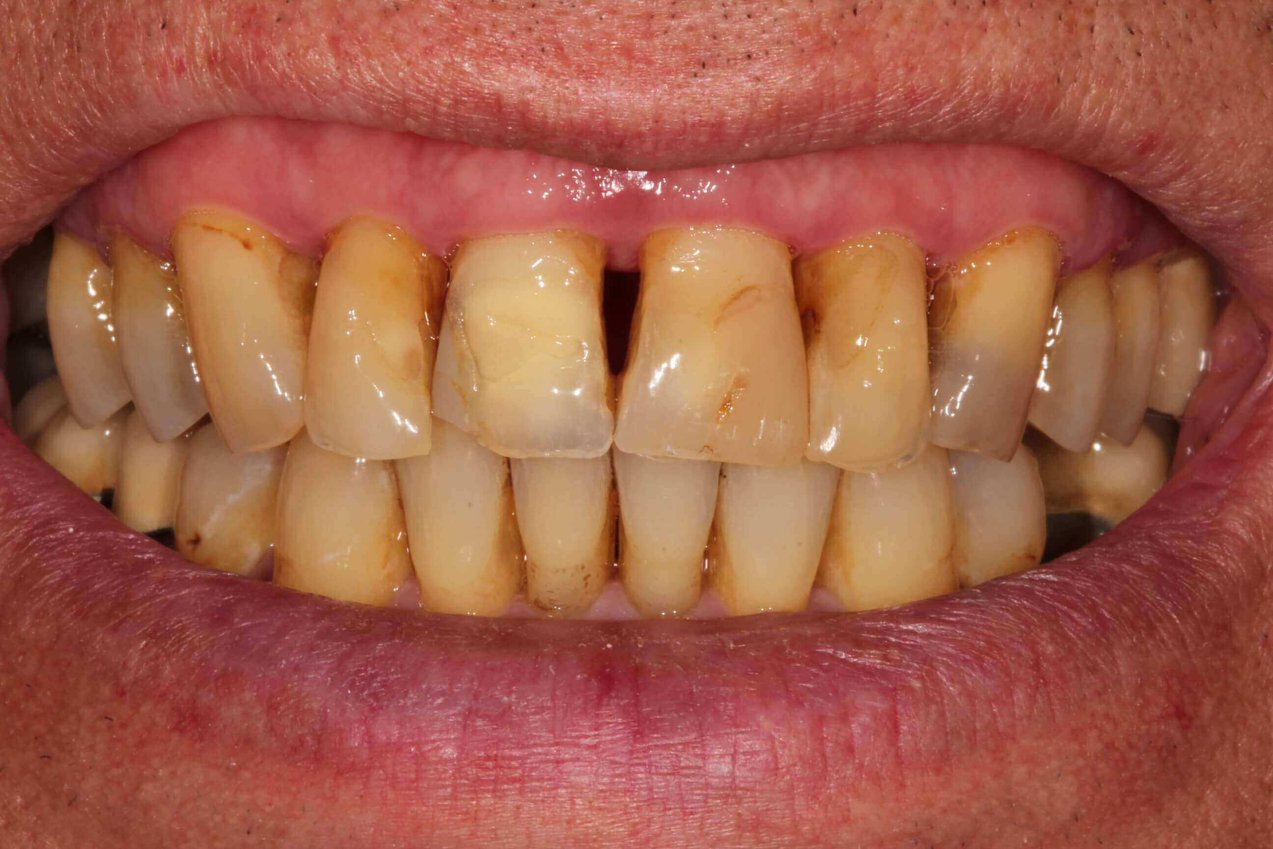 Image of teeth before treatment